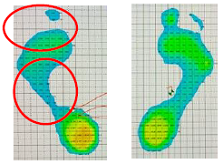 片脚立位術後７７日目