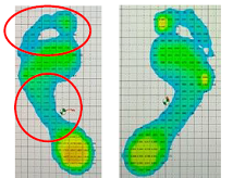 片脚立位９７日目