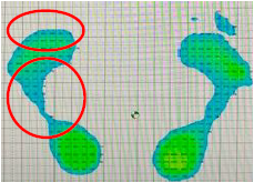 術後55日目静止立位
