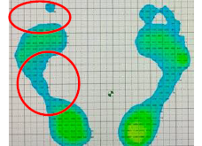 術後77日目静止立位
