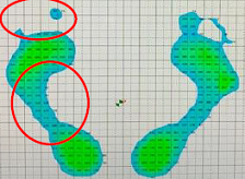 術後97日目静止立位